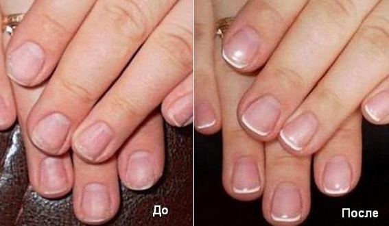 Восстановление поврежденных ногтей