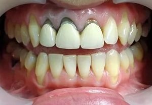 Металлокерамика: протезирование зубов