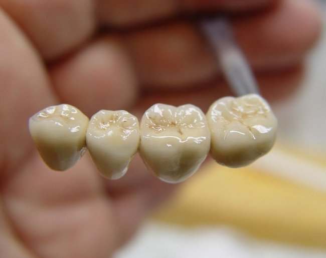 Металлокерамика: протезирование зубов