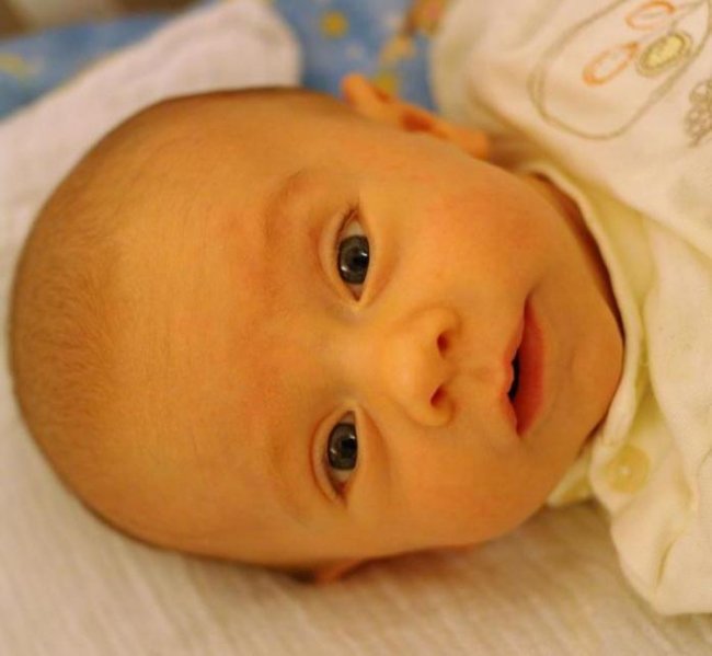 Причины желтушки у новорожденного