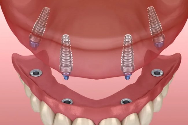 Как происходит имплантация зубов в Москве