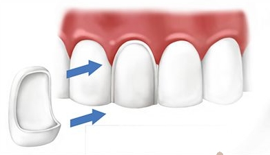 Съемные протезы в стоматологии - виды, показания, преимущества и недостатки	